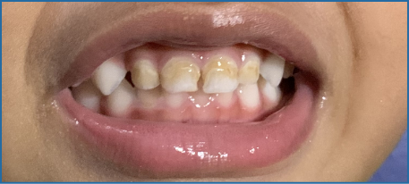 儿童牙齿上的褐色斑点图片。