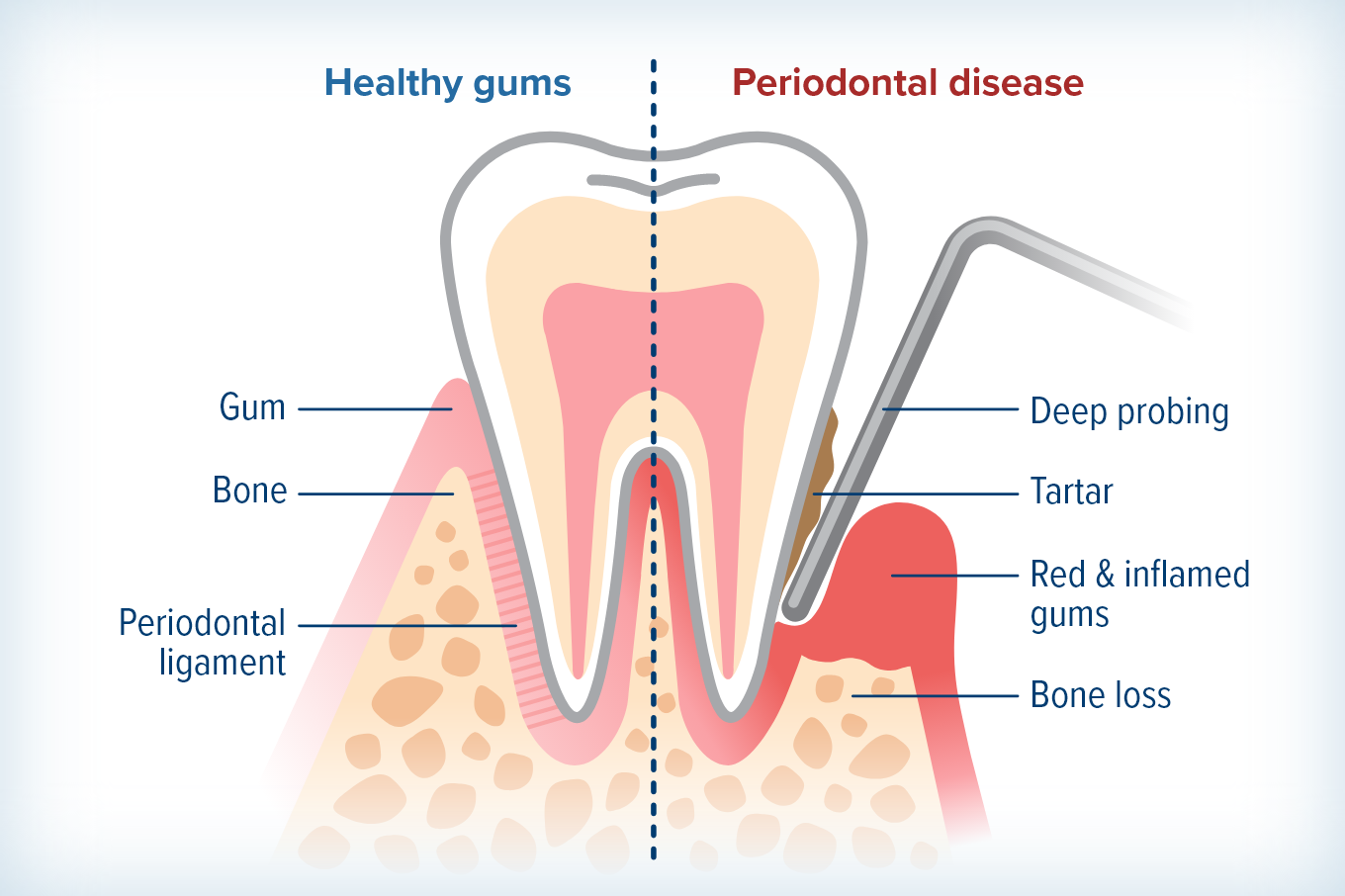 infographic showing the difference between healthy gums and gums with periodontal disease.