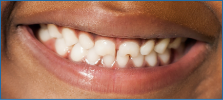 image of healthy child's teeth.