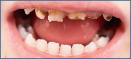 儿童牙齿上存在严重蛀牙图片。