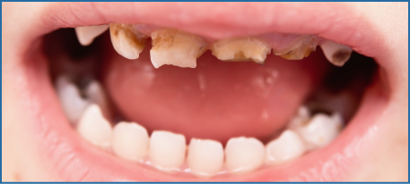 image of severe decay in child's teeth.