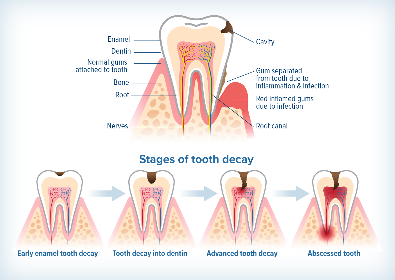 dental caries progression